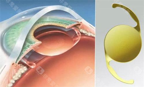 河南省人民医院做白内障手术费用是多少钱？基础型与高端晶体价格明细表！