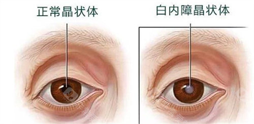 正常晶状体和白内障晶状体
