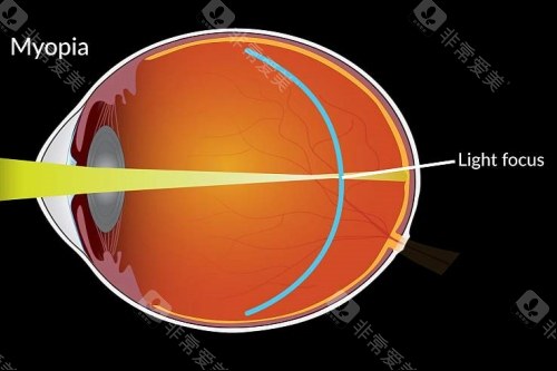 近视成像落在视网膜前