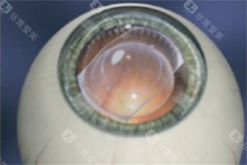 ICL晶体植入完成