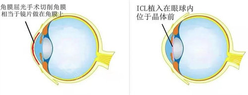 ICL植入和屈光手术