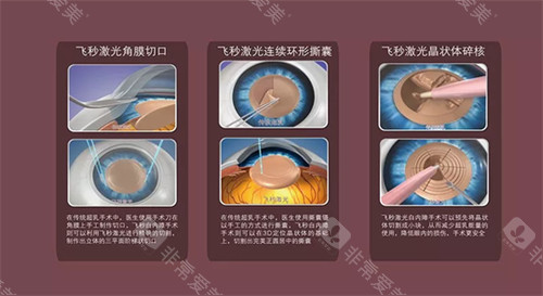 飞秒白内障手术流程