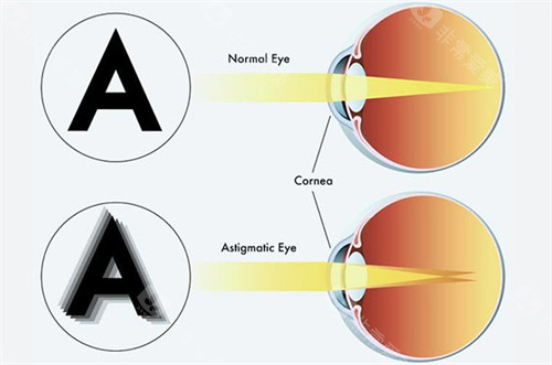 正常眼睛和弱视眼睛成像不同
