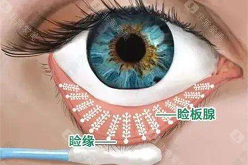 眼睛睑缘和睑板腺漫画图