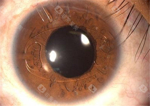 飞蚊症眼睛照片
