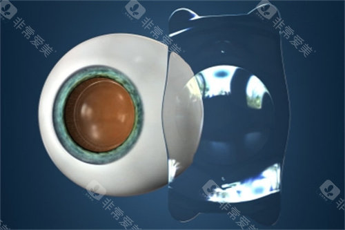 眼睛植入ICL晶体