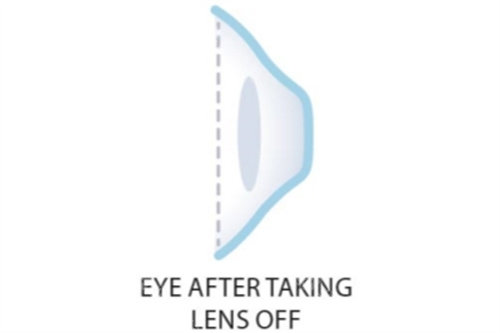 取下角膜塑形镜后