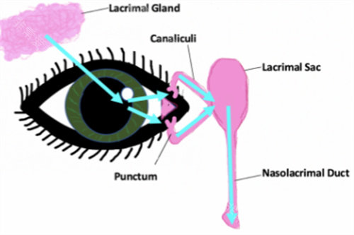 泪囊炎的样子