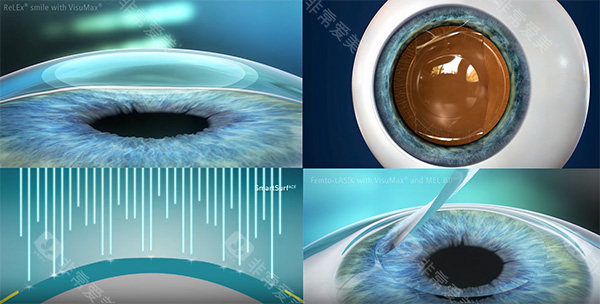 麦迪格飞秒技术原理图片