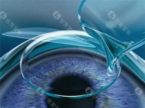 激光近视眼手术细节图