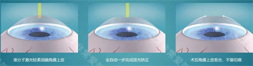 近视手术简要流程