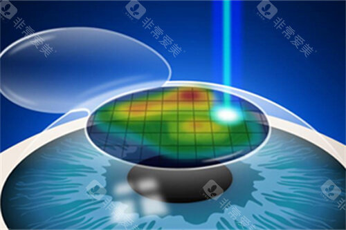 近视手术漫画示意图