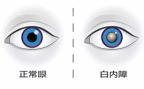 正常眼睛和白内障