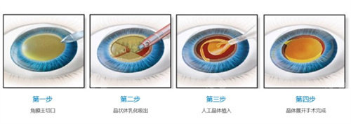 上饶铁路眼科医院哪个医生好？白内障/近视手术医生推荐与术例分享！