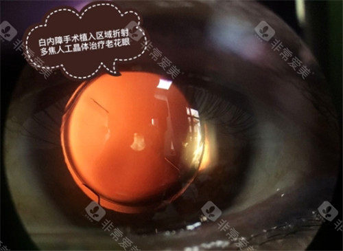 白内障手术细节图 (2)