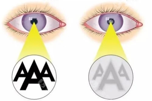 白内障与正常眼睛视物卡通图