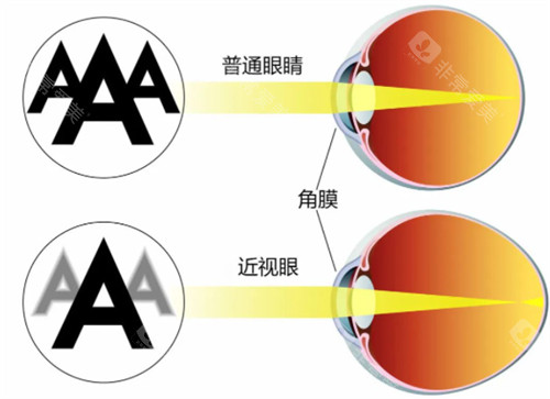 近视眼镜与正常眼睛视物区别
