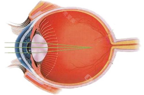 近视光线示意图