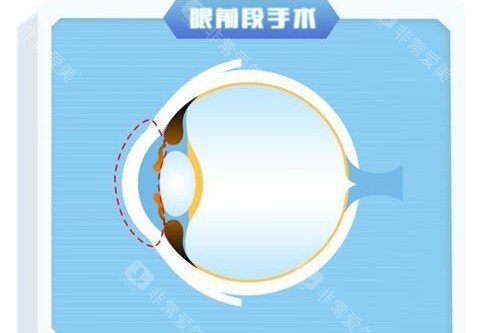 眼前段近视手术示意图