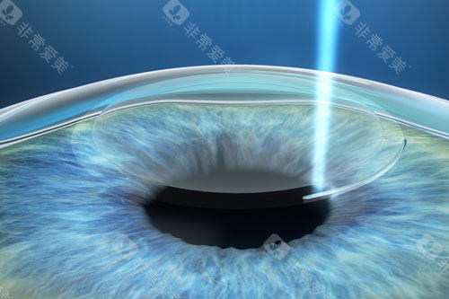 近视手术示意图