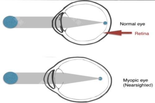 正常眼与近视眼对比