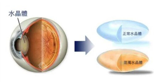 白内障的水晶体