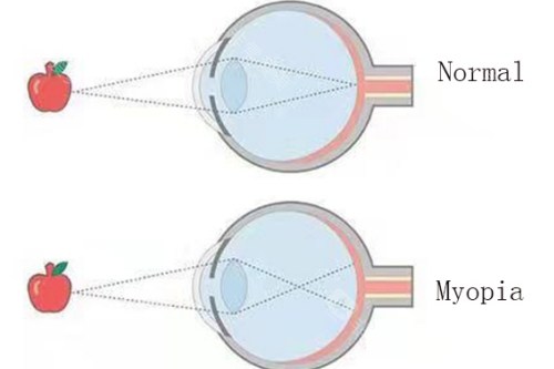 近视眼与正常眼对比