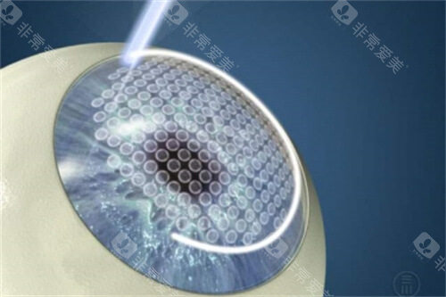 半飞秒激光手术过程