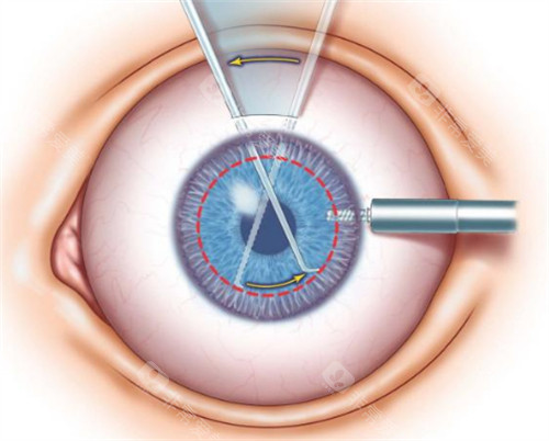 普瑞眼科医院角膜移植手术价格表3万元起,揭秘普瑞眼科医院角膜移植手术价格！