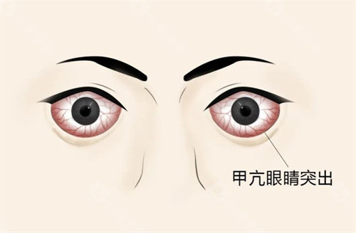 甲亢突眼的表现