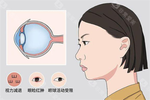 甲亢突眼的危害图解