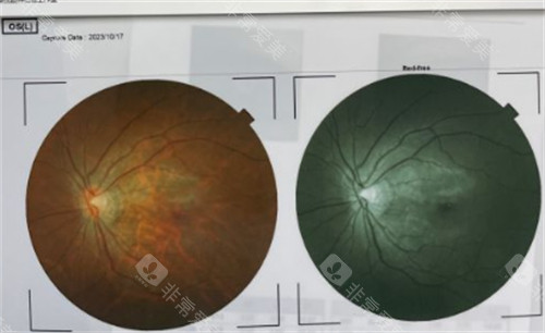 太原爱维视眼科检查结果图片