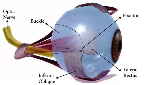 上海后巩膜加固手术哪家好？和平眼科/新视界眼科/华厦眼科做后巩膜加固术技术好!