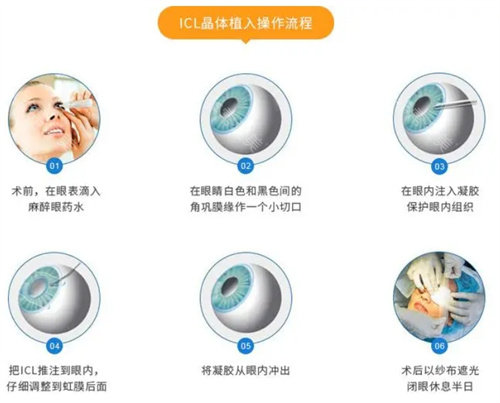 ICL晶体植入手术流程