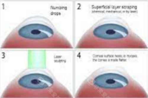 smart全激光手术过程