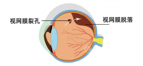 视网膜芯片现在临床应用了吗?从实验室研究阶段正式进入了临床应用的初期！