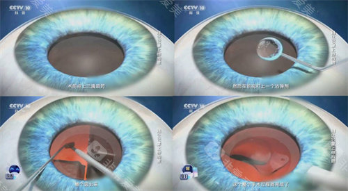 白内障手术流程简图