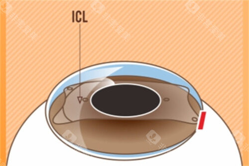 ICL晶体植入后示意图