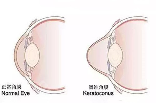 圆锥角膜与正常眼睛展示图
