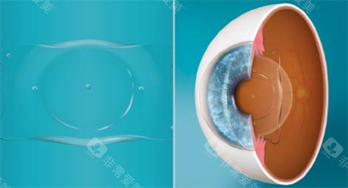 人工晶体植入眼睛的层次