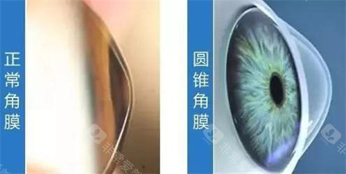 正常角膜与圆锥角膜图片