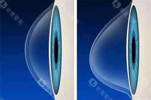 圆锥角膜角膜照片