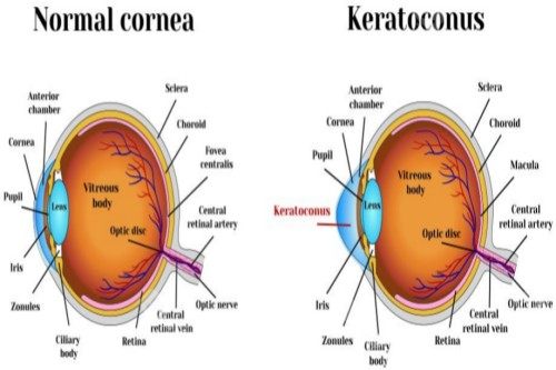 正常眼球结构与圆锥角膜眼球对比