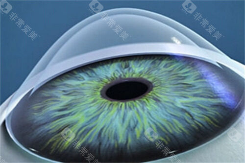 清晰的圆锥角膜示意图