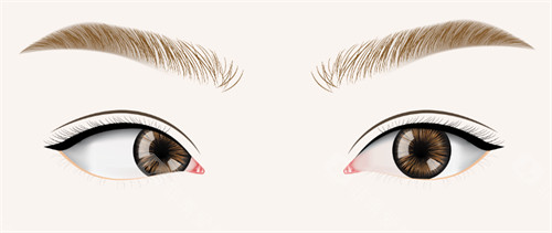 斜视眼睛和正常眼睛