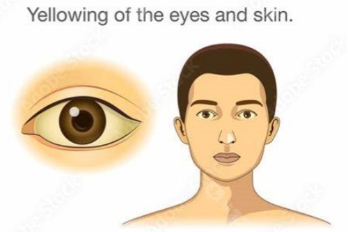 眼睛发黄