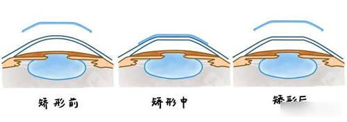 晶体植入矫正近视前中后漫画示意图