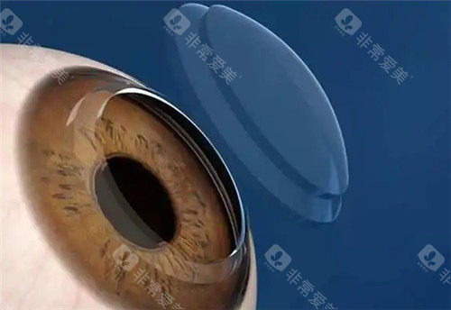 角膜塑形镜佩戴图