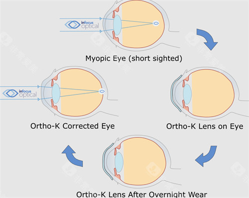 重庆南坪爱尔杨和平医生怎么样?青少年近视防治_角膜塑形镜验配_视光专科口碑佳!