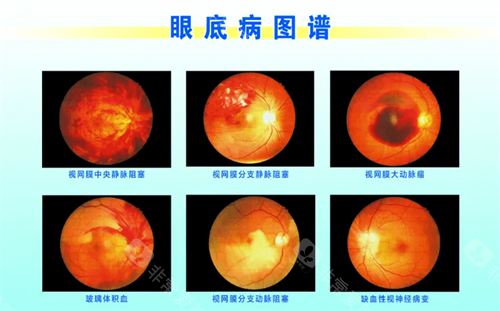 眼底病图谱示意图